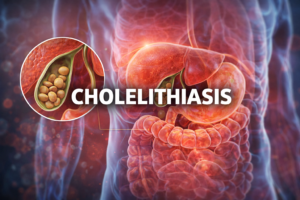 Cholelithiasis